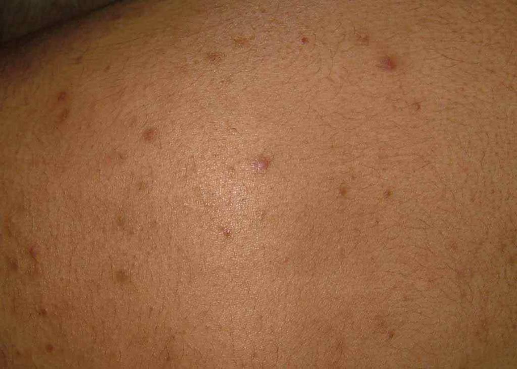 Common Skin Infections...